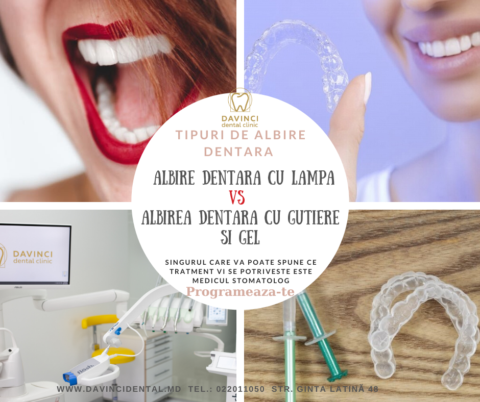 albire dentara cu lampa vs albire dentara cu cape si gel de albire